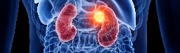 Mystery risk factor linked to high rates of kidney cancer, major DNA study finds